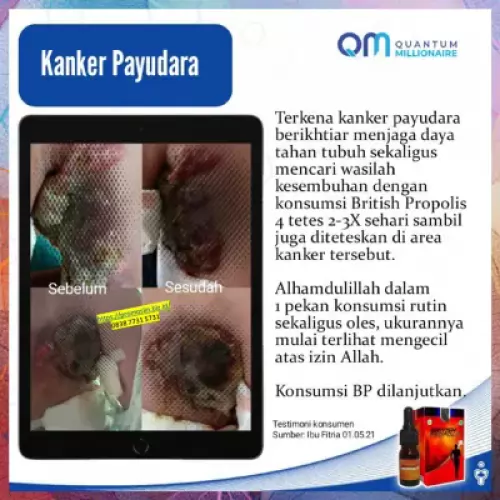 testimoni-british-propolis-mengatasi-benjolan-payudara